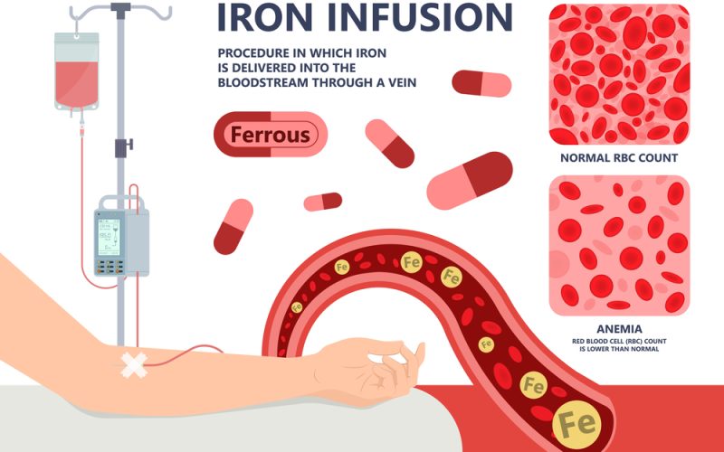 When You Need an Iron Infusion vs Oral Supplements