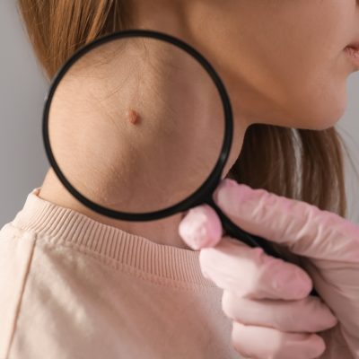 How to Know if Your Skin May Have Skin Cancer (and Why Early Signs Matter More Than You Think)